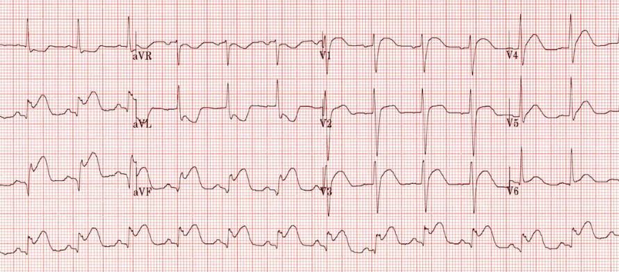Überlebens-Wahrscheinlichkeit nach STEMI
