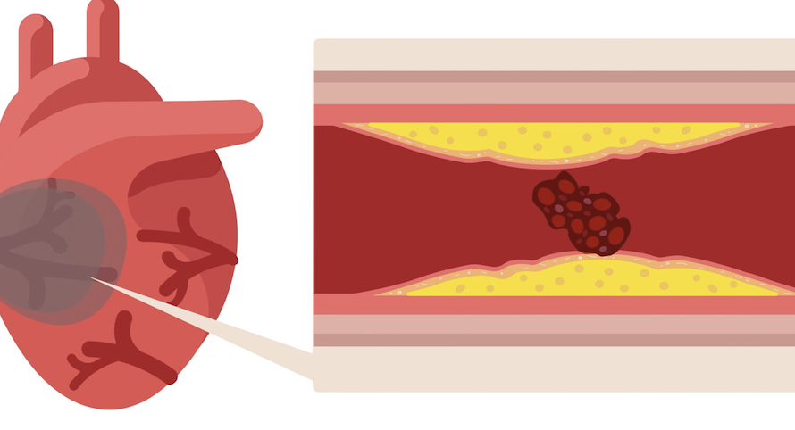 Koronare Herzkrankheit – Therapie