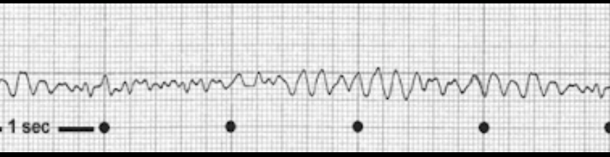 Defi-Einsatz in Schweden