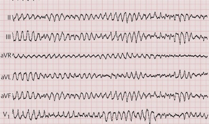 Sport und plötzlicher Herztod